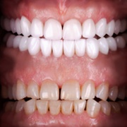 Veneers