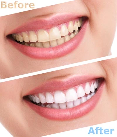 before and after teeth whitening treatment