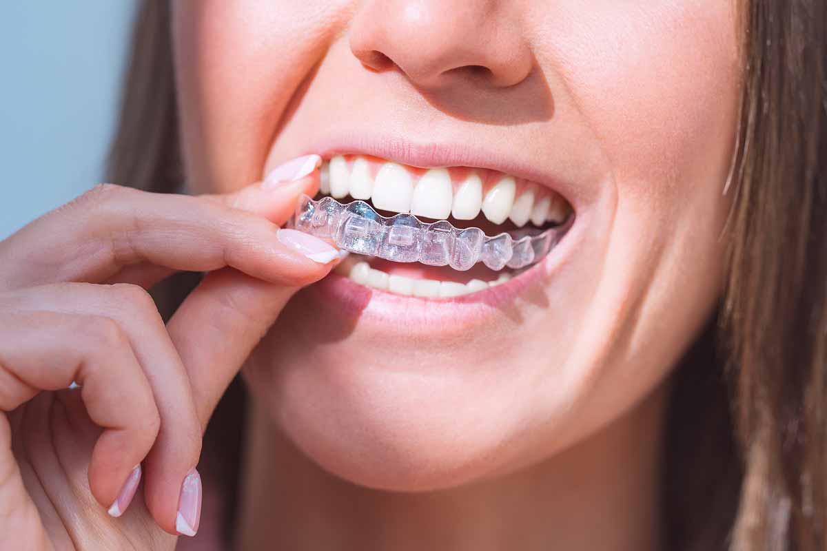 Laurel Bush Family Dentistry in Bel Air, MD offers clear aligners