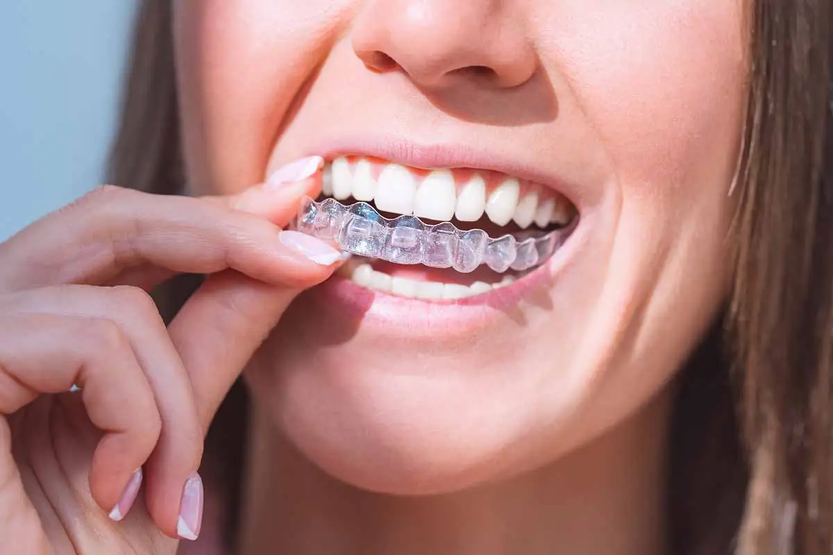 Laurel Bush Family Dentistry in Bel Air, MD offers clear aligners